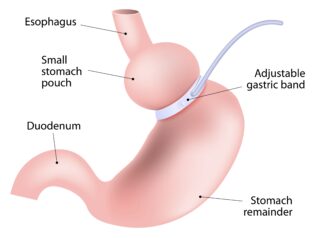 Inel gastric.