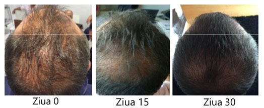 Pacient cu alopecie dupa tratamentul Rigenera
